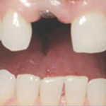 West Covina Dentist teeth implants