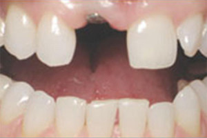 West Covina Dentist teeth implants