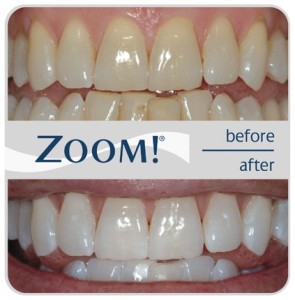 Zoom Laser Teeth Whitening